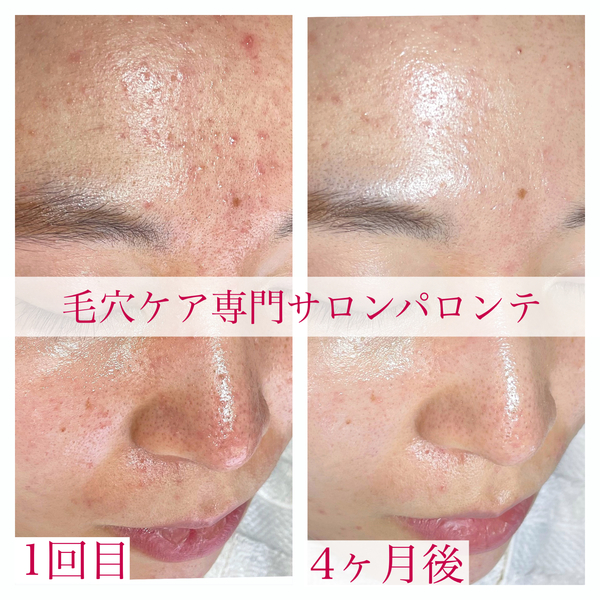 毛穴に効果があると思ったハーブピーリング