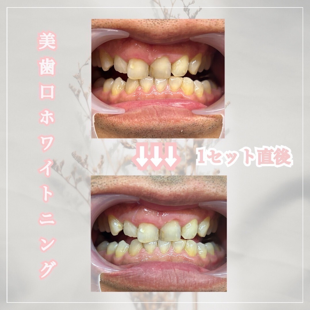 美歯口 ホワイトニング 美歯口ホワイトニングはじめませんか？