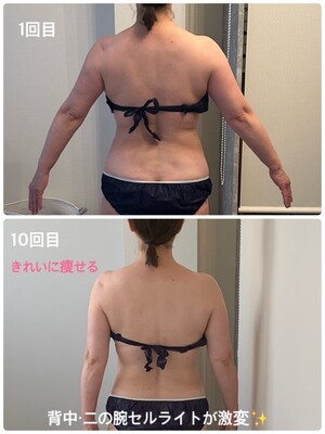 セルライト除去!!ミニセル セルライトケア美容器 ミニセル セルライト除去 ダイエット