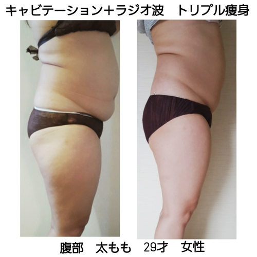 大人気！キャビテーション＋ラジオ波＋吸引『トリプル痩身』60分