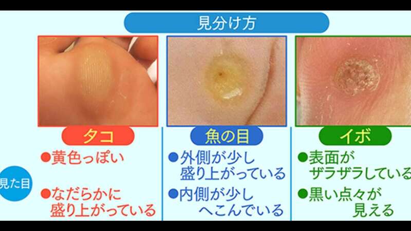 【裁断済】疣贅のみかた、治療のしかた 疣贅(いぼ)のみかた,治療のしかた | 江川清文, 江川清文 |本
