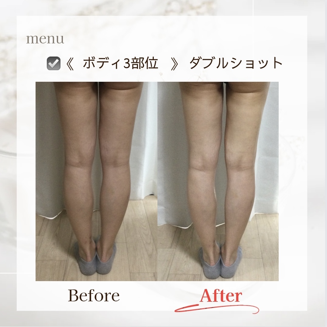 2年前くらいに3万円で買いました、ほぼ使っていません、脂肪をモミモミ痩身機械 2年前くらいに3万円で買いました、ほぼ使っていません、脂肪をモミモミ