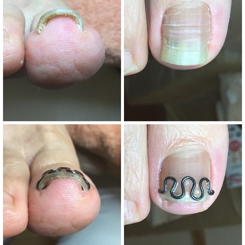 BS スパンゲ クイック 巻き爪 ビーエス 28スティック B/S おまけつき 巻き爪矯正(B/Sブレイスクイック)｜ネイルサロン＆スクール