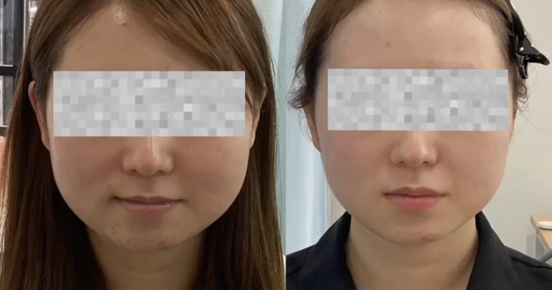 ハイフで小顔。エレクトロポレーションで美肌。