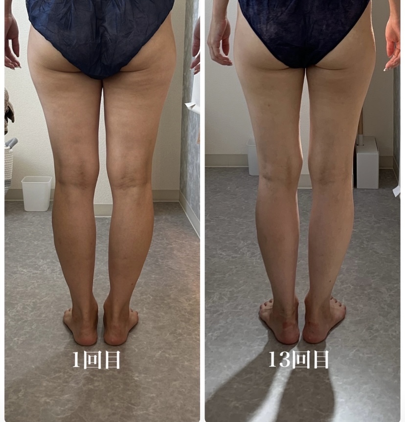 ulson痩身 気づいてない！？ あなたの背骨🦴ガチガチかも🥶⚡️ 今日はガチガチ