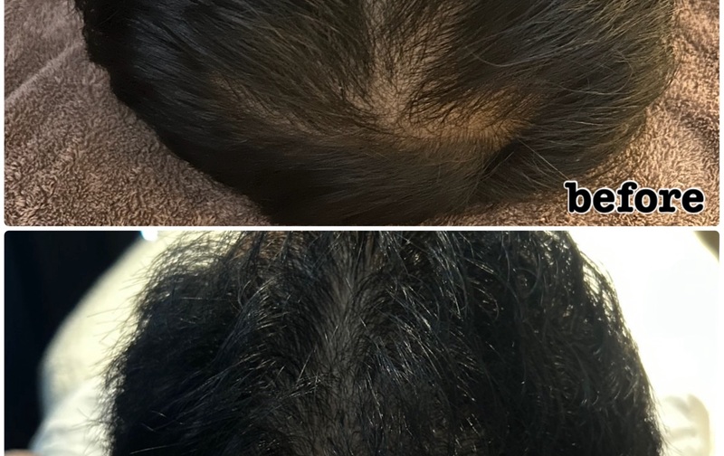 韓国育毛CURAIM 【Tゾーン】スタンダードコース（月1回）