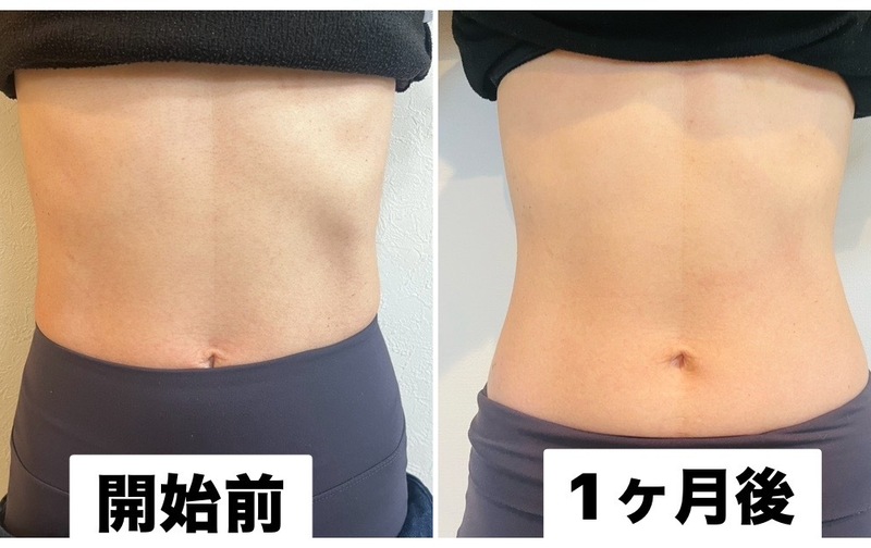 肋骨締めベルト