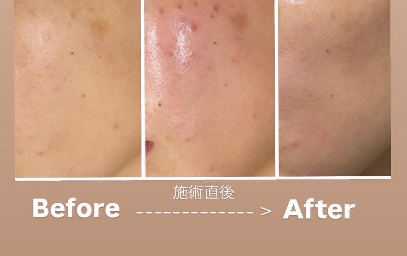 シミケア3回チケット