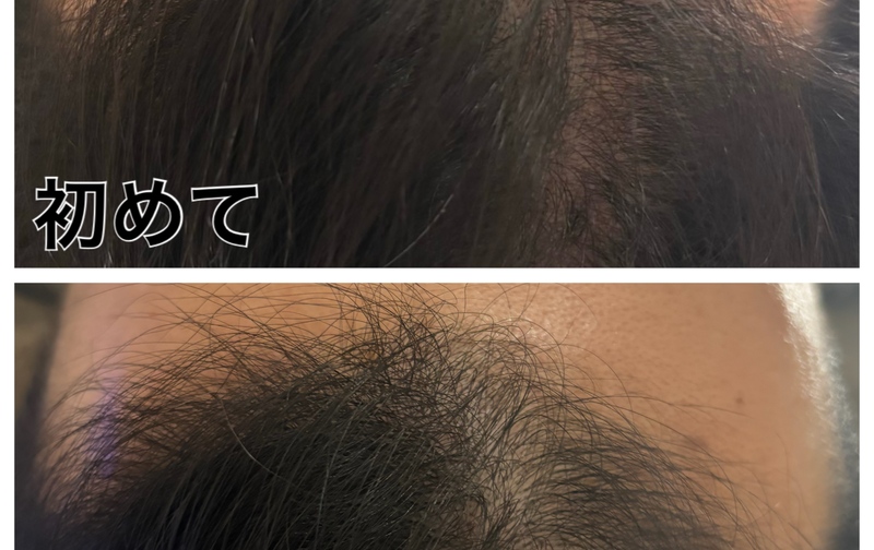 韓国育毛CURAIM 【全頭】プレミアムコース（月1回）