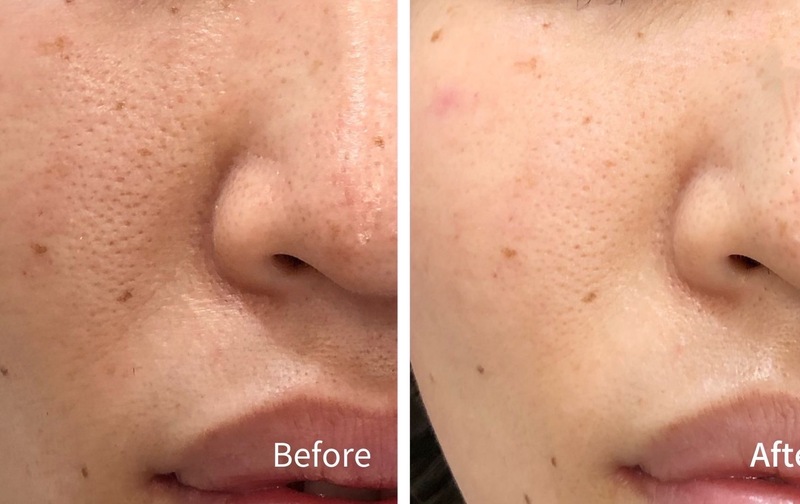 毛穴洗浄 4回券