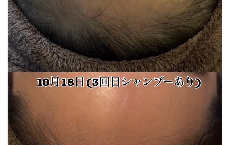 韓国育毛CURAIM 【1部位】ライトコース（月1回）