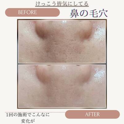 初回限定☆肌質改善美肌脱毛＋小顔メニュー無料体験