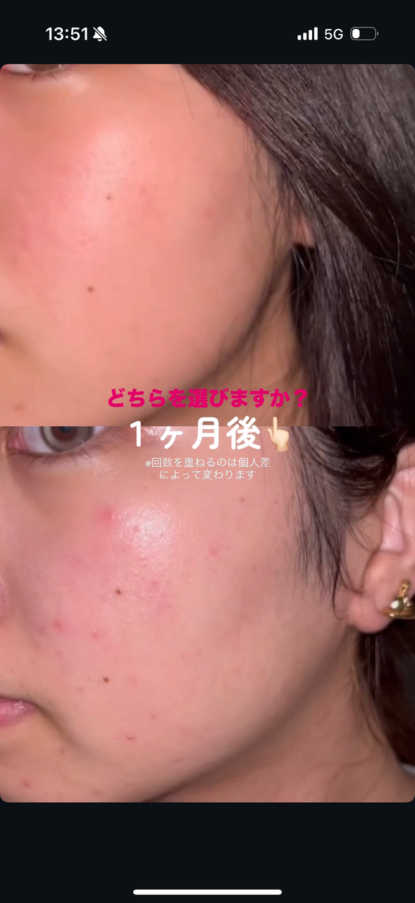 【初回お試し】剝離なしハーブピーリング