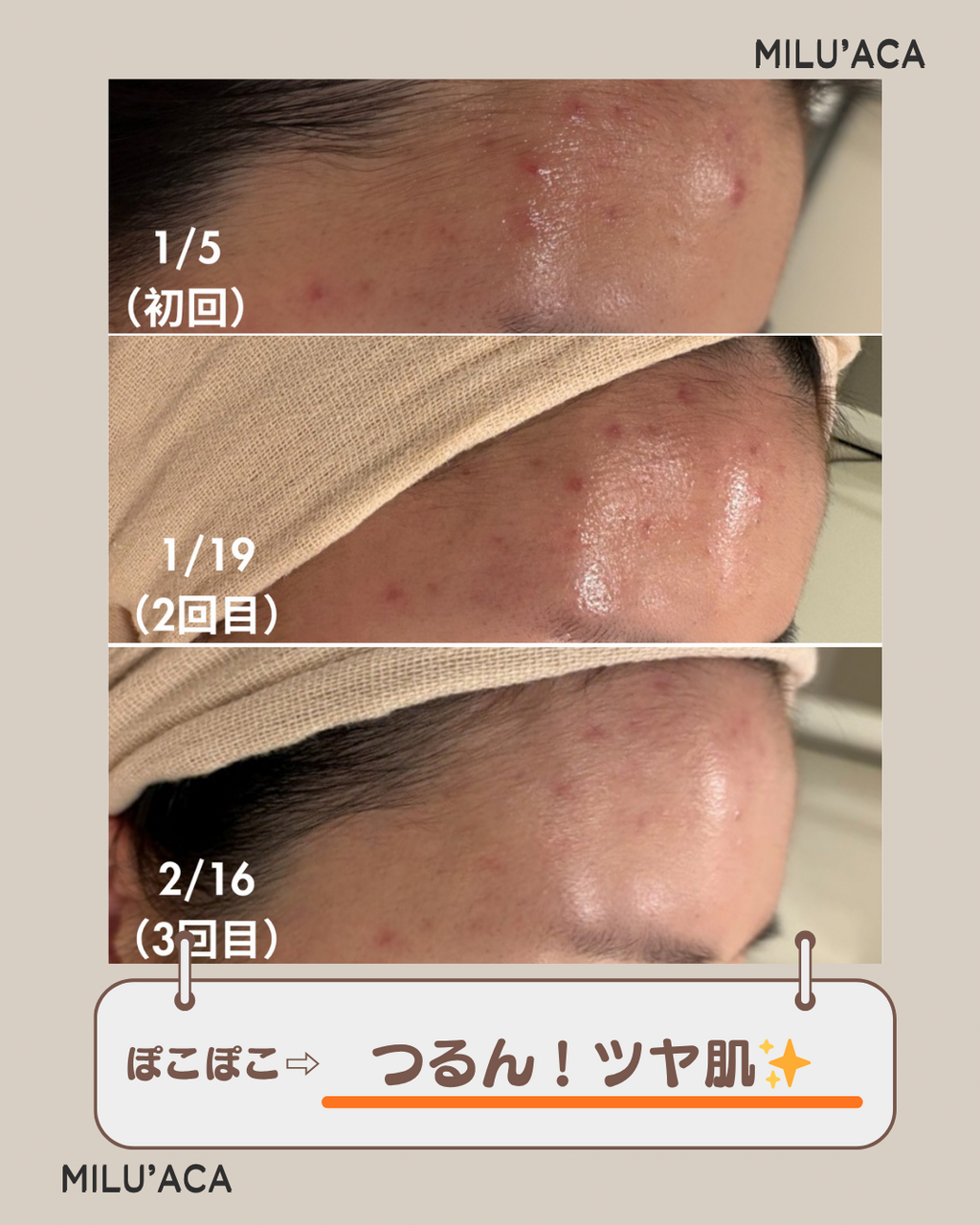 ハーブピーリング】自分ケアでは限界 その肌悩みを根本から変えたい