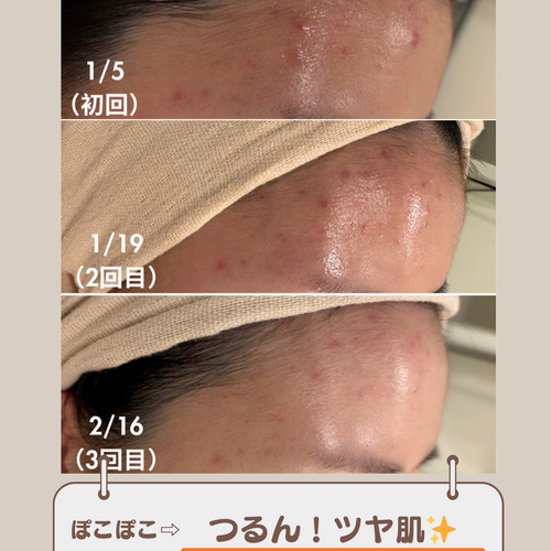 ハーブピーリング】自分ケアでは限界 その肌悩みを根本から変えたい