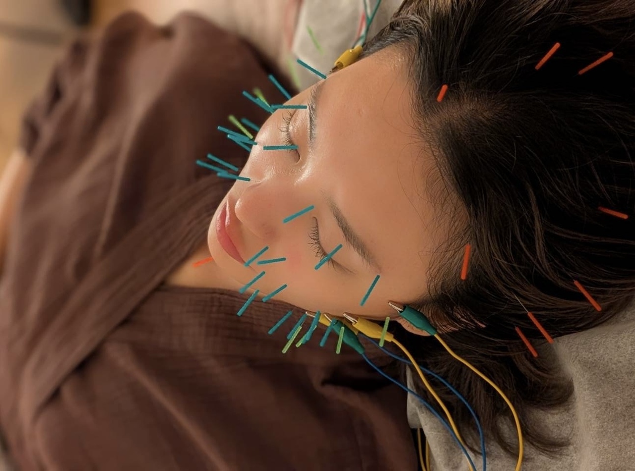 【30分】美容鍼/Noriko