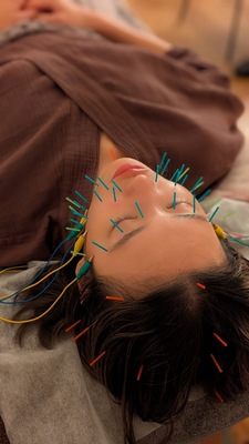 【30分】美容鍼/Noriko