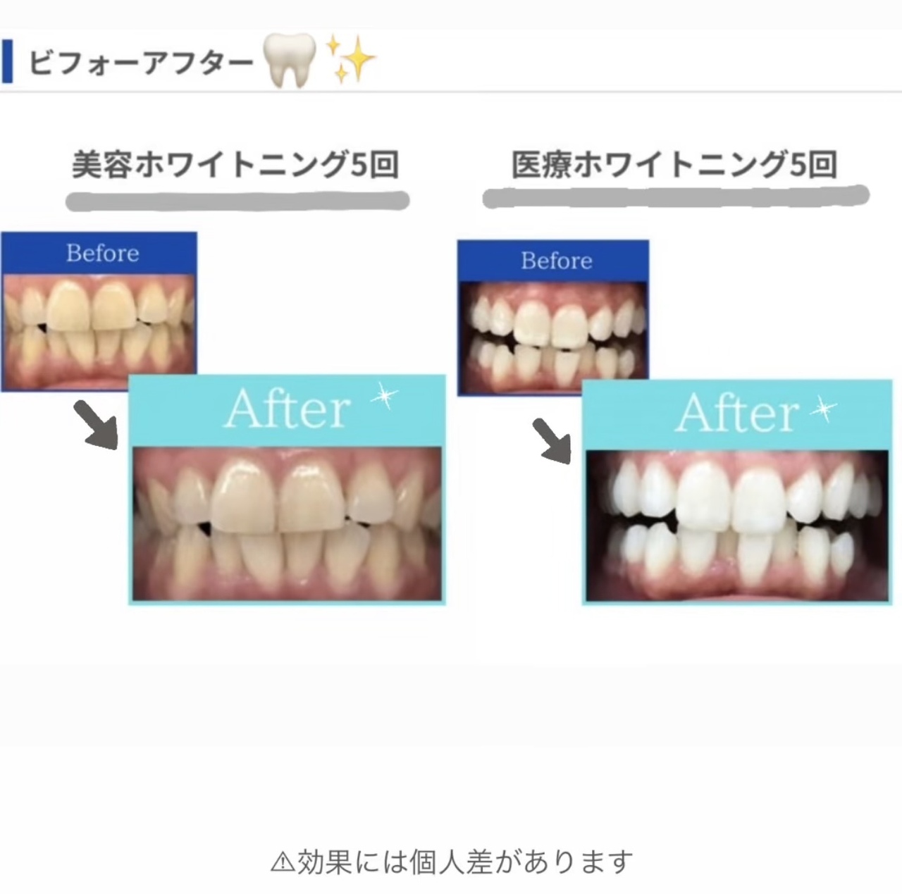 【医療提携】ホワイトニングメニュー導入　単品可 楽天市場】ホワイトニングジェル ホーム セルフ 自宅 PAP ケア 9ml
