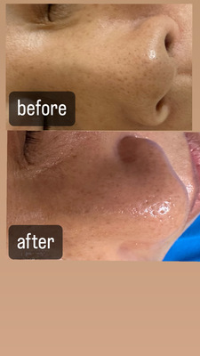 フェイシャルエステ