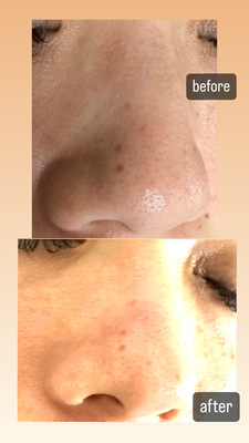 フェイシャルエステ