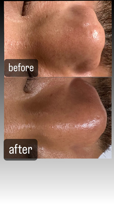 フェイシャルエステ