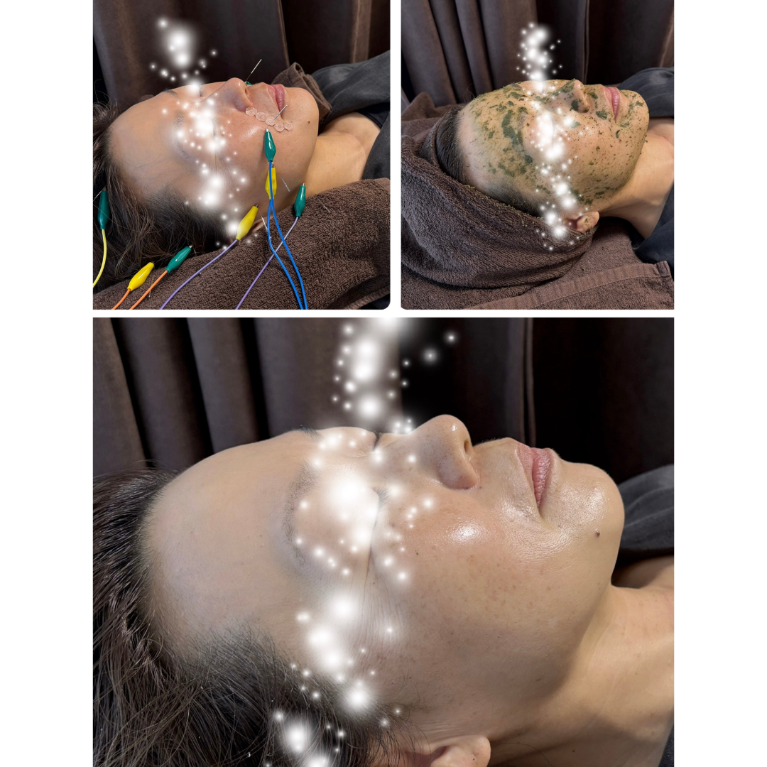 立体造顔美容鍼®️・リンパ疎通美容鍼