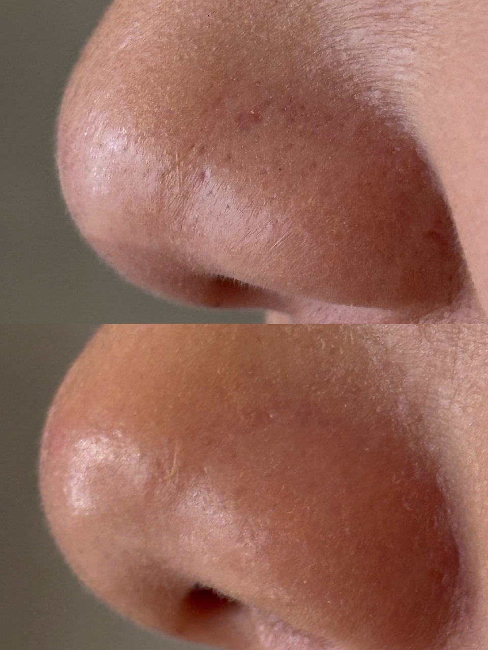 毛穴トラブル改善メニュー