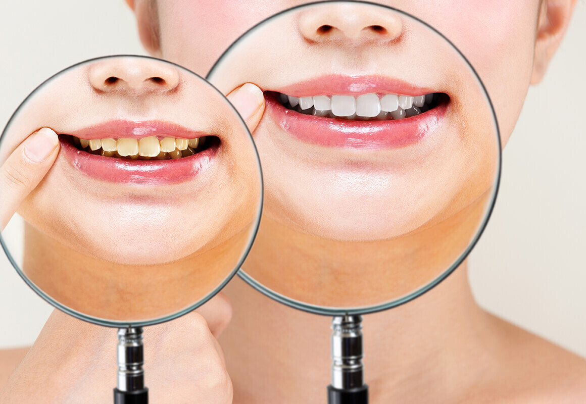 セルフホワイトニング　1回（お試しやメンテナンスに）【月謝・回数券のお客様専用】