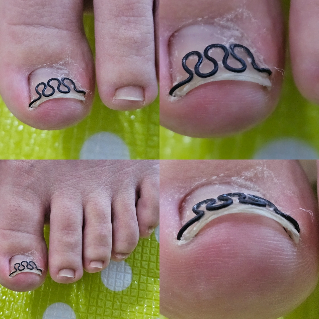 切りずらい足指の爪切り・ツメフラ法巻き爪施術