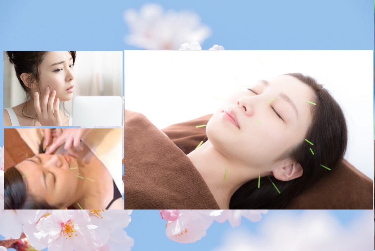 体質面から若返る美容鍼灸3ヶ月集中プラン 予約受付中！