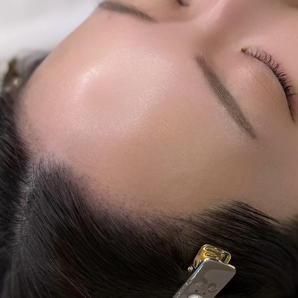 スカルプ（ドット式）