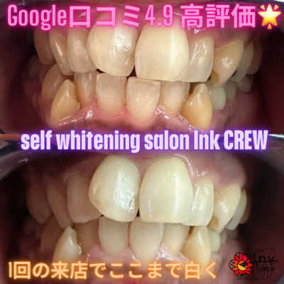 セルフホワイトニングサロン　lnk.CREW 予約はこちらからになります✨
