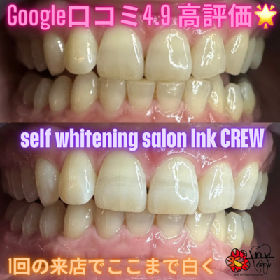セルフホワイトニングサロン　lnk.CREW 予約はこちらからになります✨