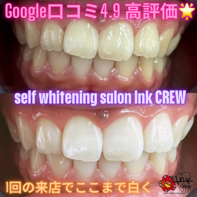 セルフホワイトニングサロン　lnk.CREW 予約はこちらからになります✨