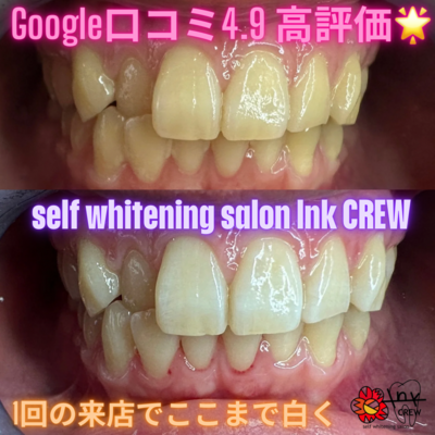 セルフホワイトニングサロン　lnk.CREW 予約はこちらからになります✨
