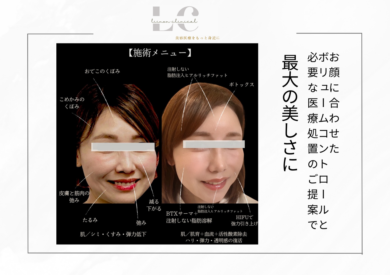 たるみ改善【顔脂肪ケア×引き締め】