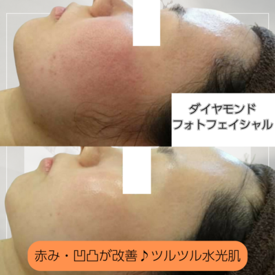 脱毛・フェイシャル・瘦身エステのご予約はこちら