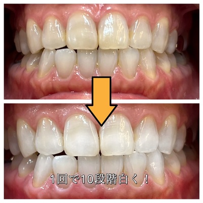 一回で白い歯ホワイトニング（新規様・リピーター様）