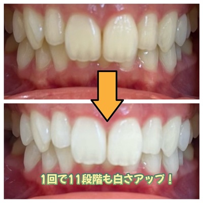 一回で白い歯ホワイトニング（新規様・リピーター様）