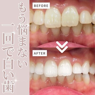 一回で白い歯ホワイトニング（新規様・リピーター様）
