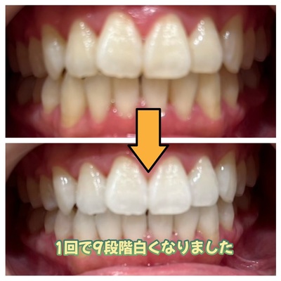 一回で白い歯ホワイトニング（新規様・リピーター様）