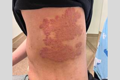 帯状疱疹予防接種ワクチン