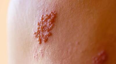 帯状疱疹予防接種ワクチン