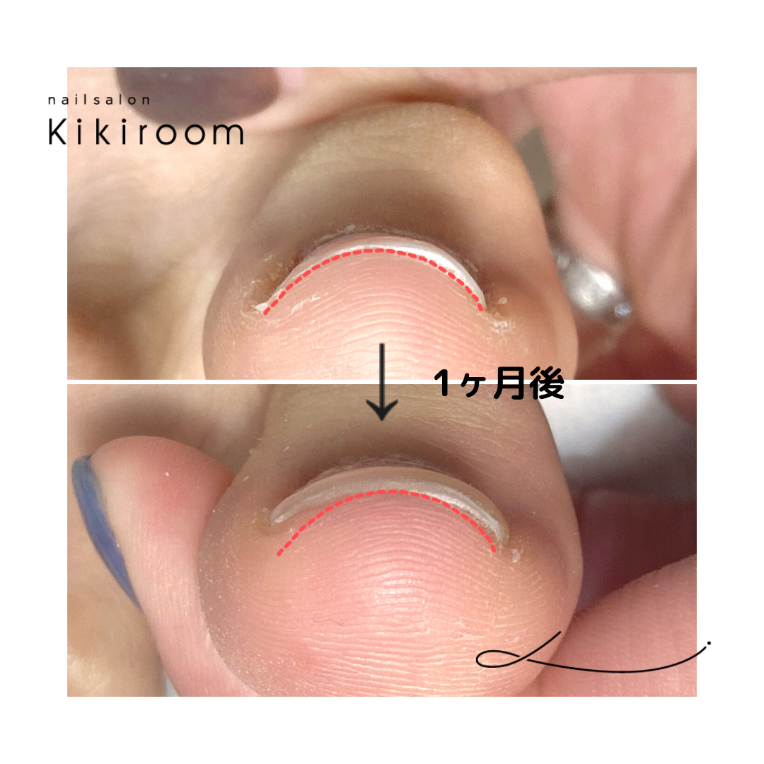 巻き爪ケア【フットのみ】