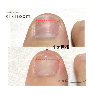 巻き爪ケア【フットのみ】