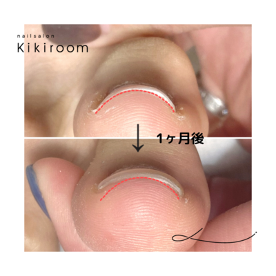 巻き爪ケア【フットのみ】