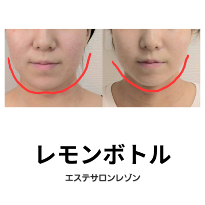 ご新規様ご予約☆ニキビケア・エンビロンエステ・ブライダルエステ：レゾン京橋店