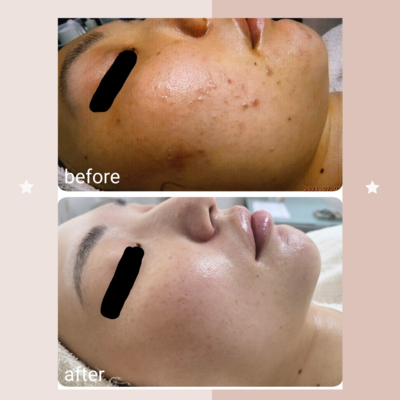 ご新規様ご予約☆ニキビケア・エンビロンエステ・ブライダルエステ：レゾン京橋店