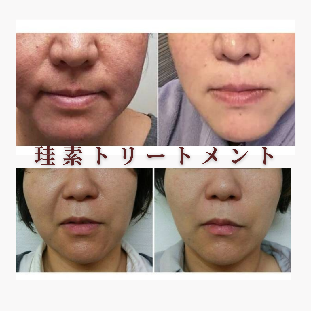 顔つぼエステ /珪素トリートメント