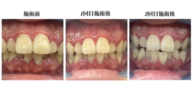 セルフホワイトニング
